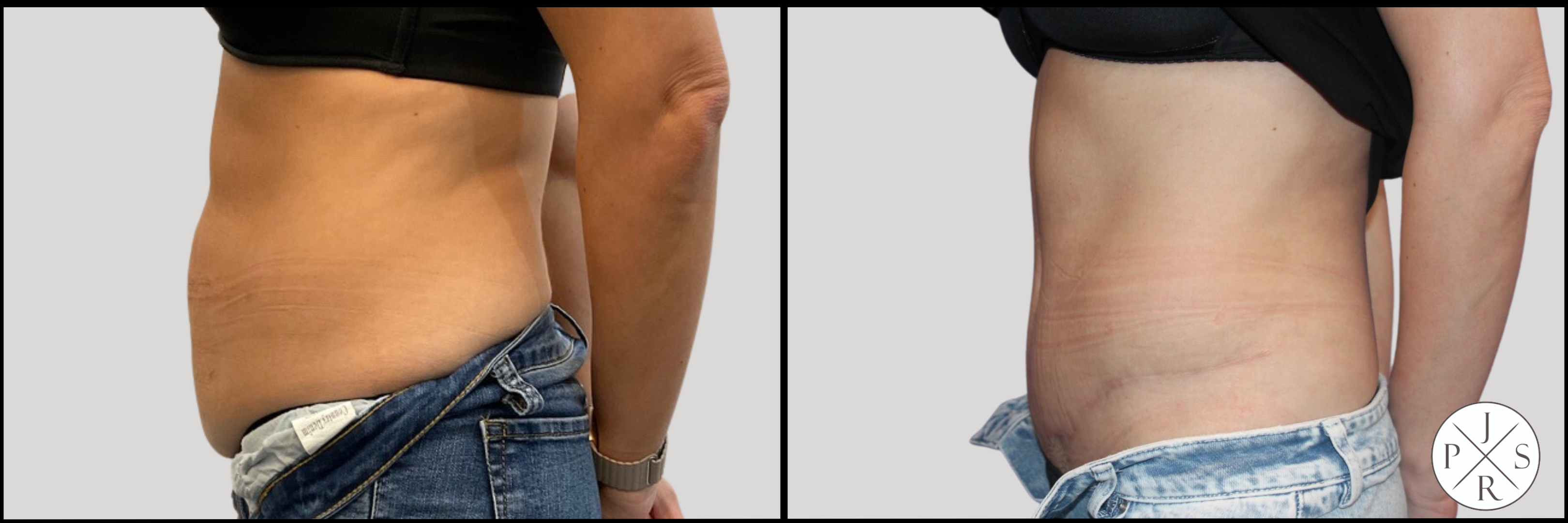 Abdominoplasty Before & After Image